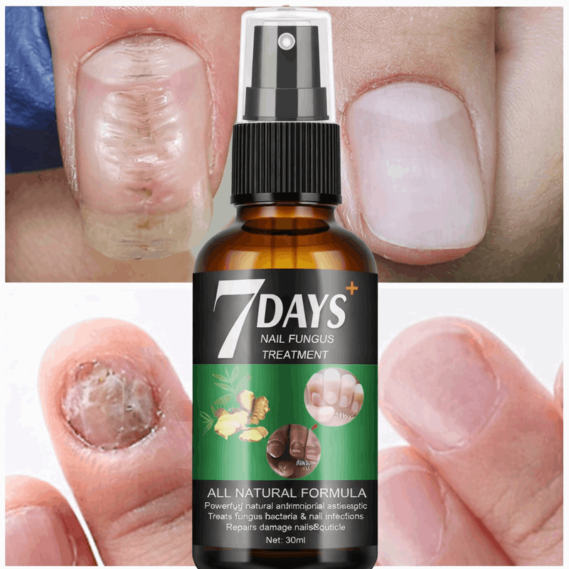Belleza 7 Days Nails Ecuador – Trata los Hongos y Recupera tus Uñas en una Semana de Tendeli- Ecuador en